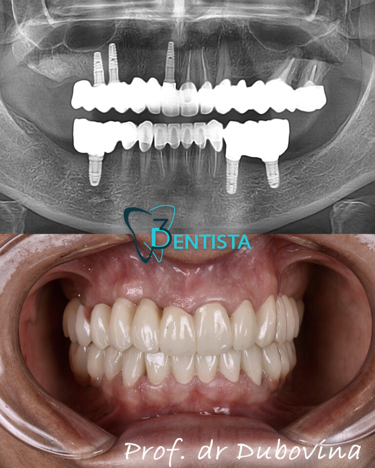 Krunice, navlake, beli zubi, zirconia