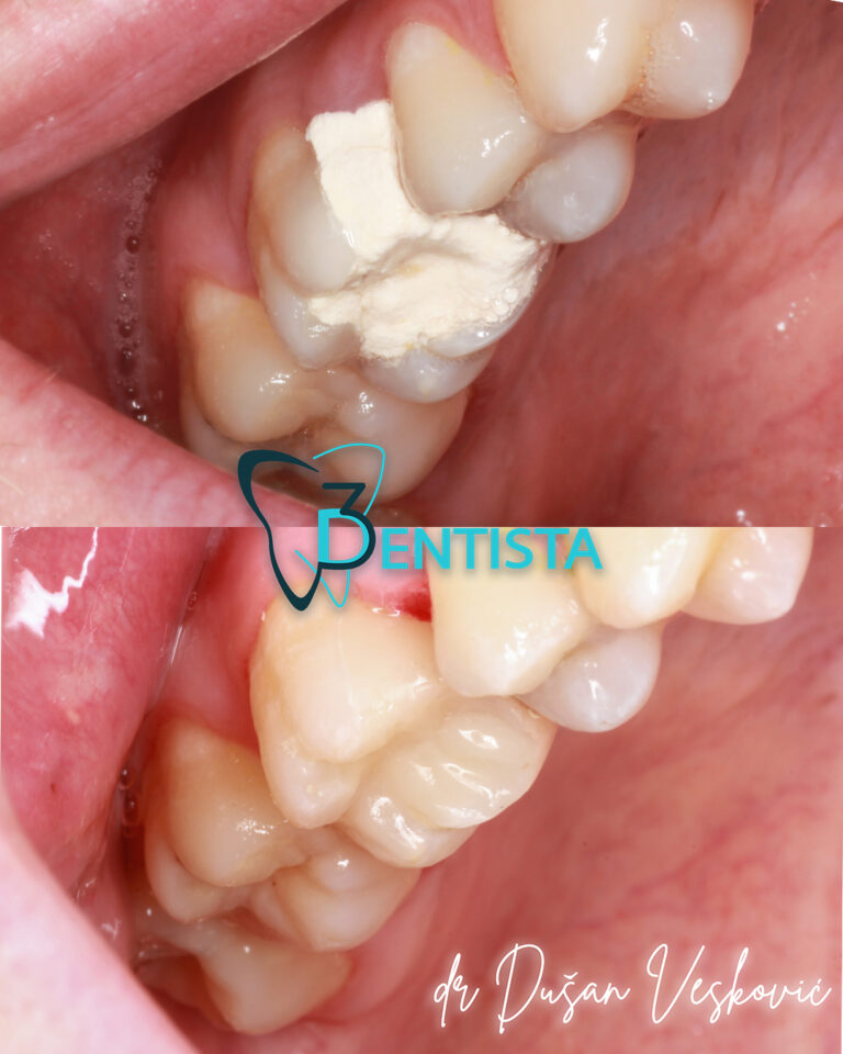popravka zuba, bela plomba, beli zubi, izbeljivanje zuba, kompozitne fasete