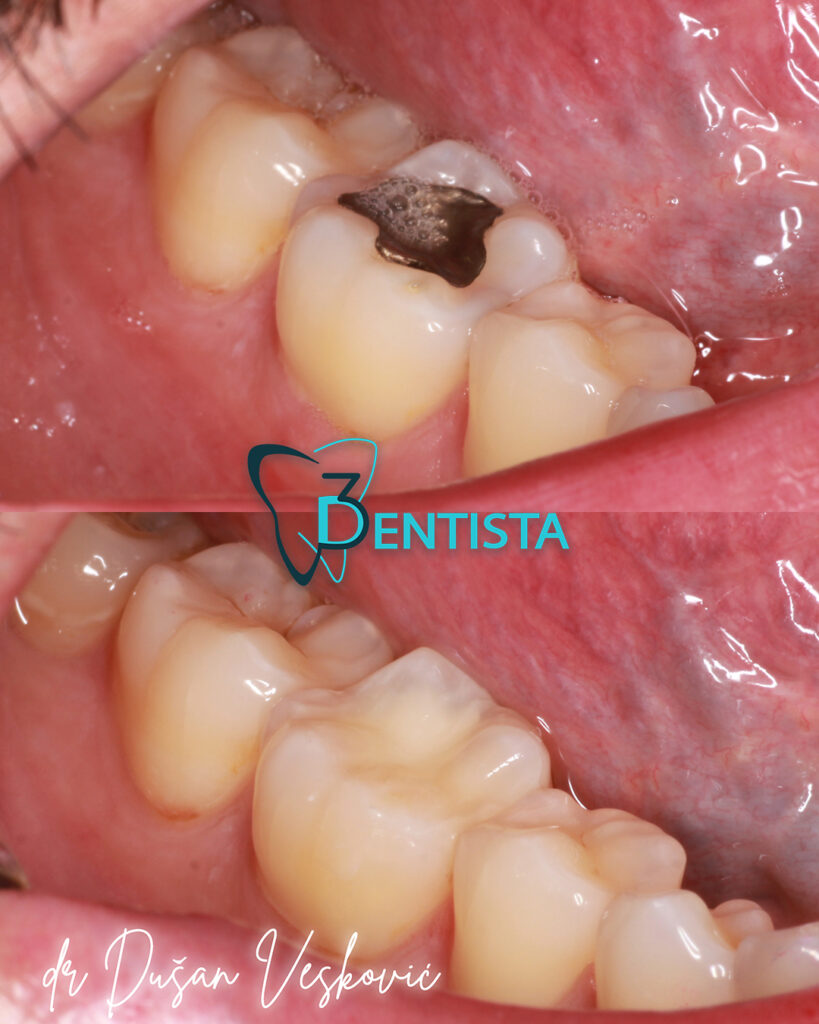popravka zuba, bela plomba, kompozitni ispun dr Dusan Veskovic, stomatolog Novi Beograd