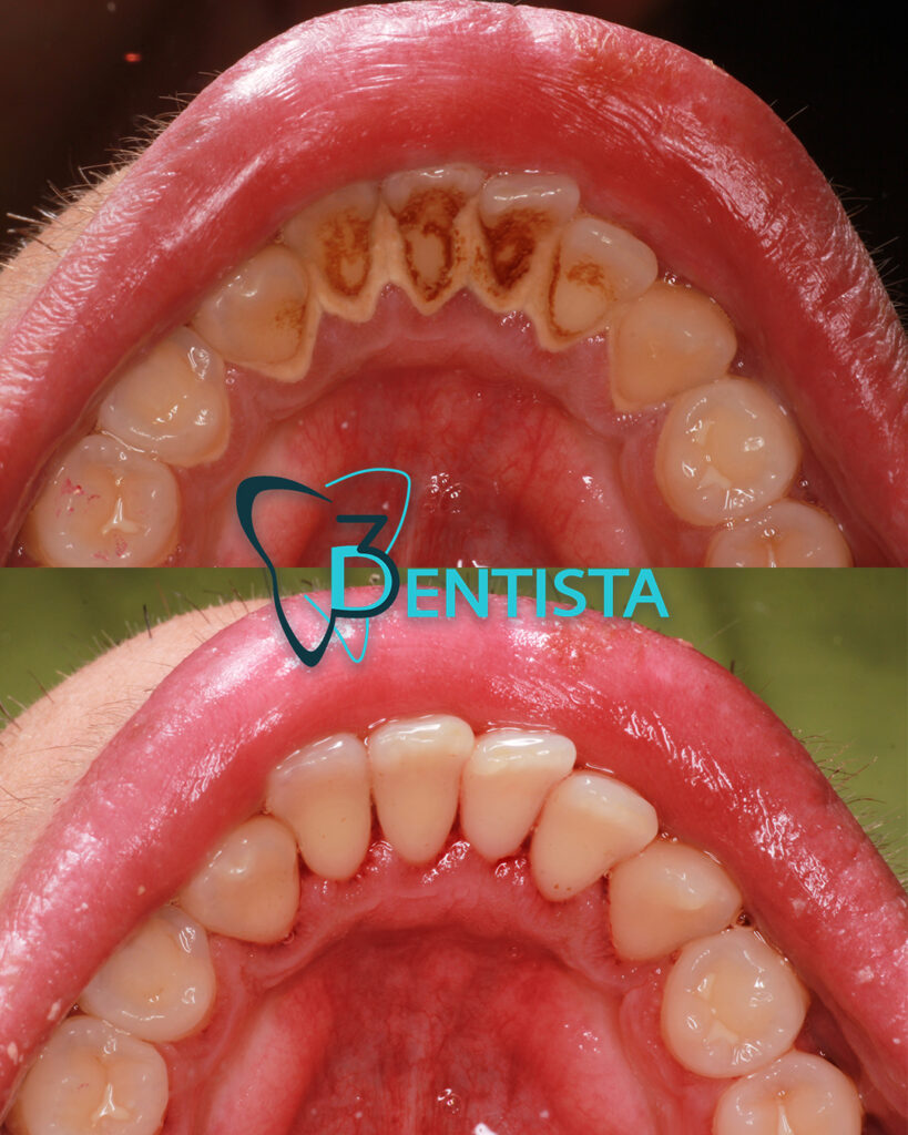 uklanjanje zubnog kamenca, stomatolog, Novi Beograd, dr Dusan Veskovic, 3Dentista