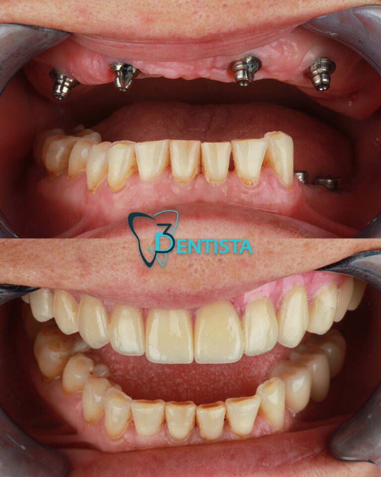 all on four, implantati, implanti