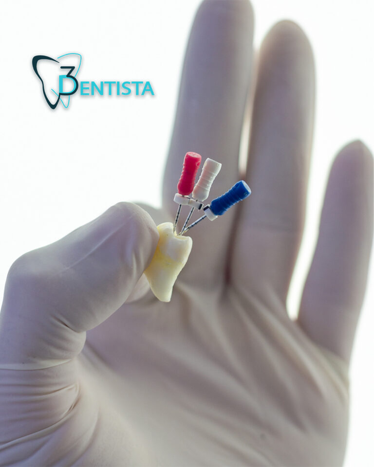 endodoncija, lecenje kanala, vadjenje zivca